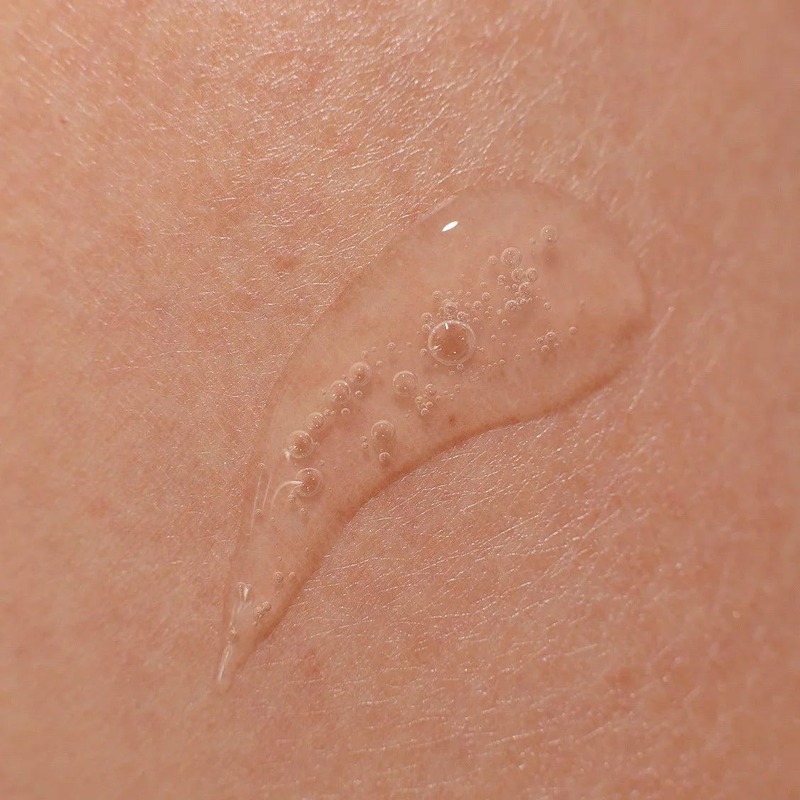 Active gel "Anti-acne SOS"