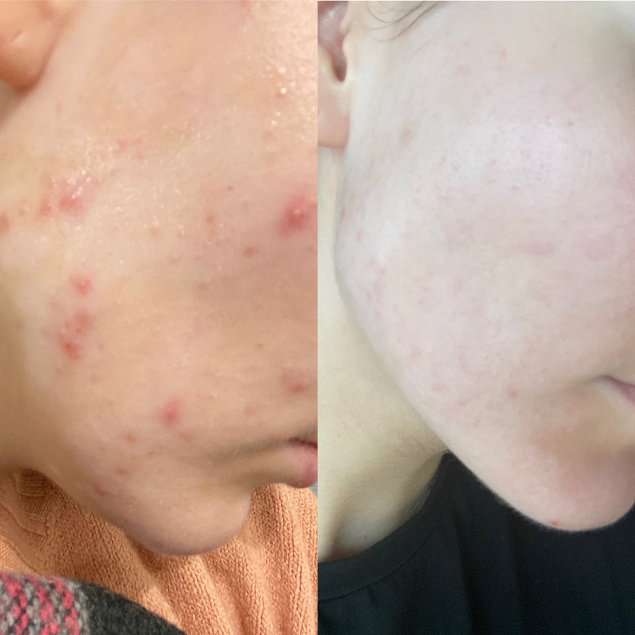 Toning Serum for Acne Prevention SKIN BALANCE