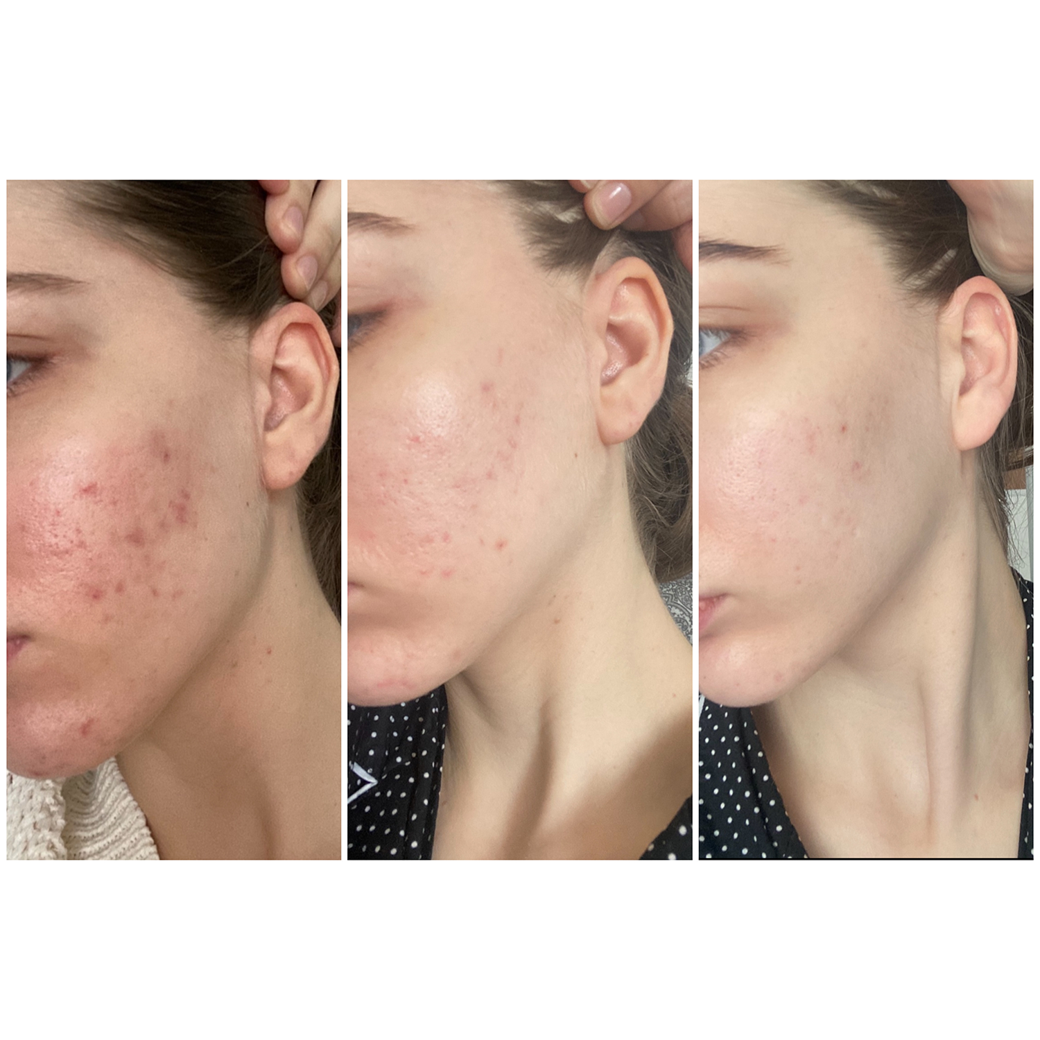 Toning Serum for Acne Prevention SKIN BALANCE